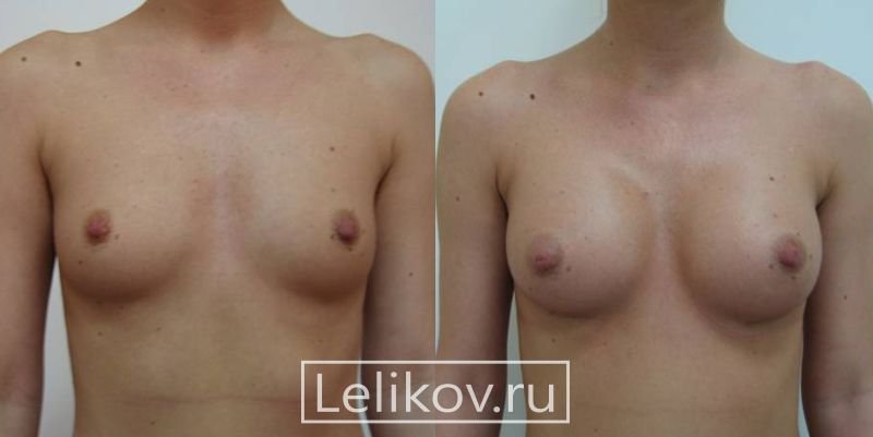 До и после увеличения груди Леликов