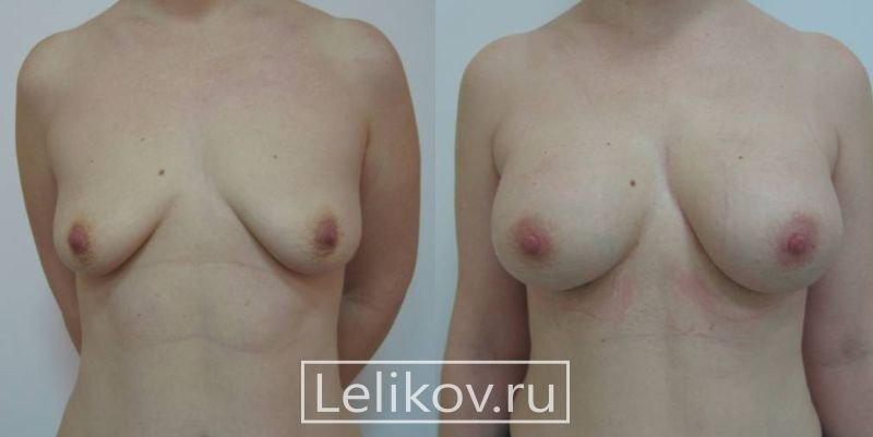До и после увеличения груди Леликов